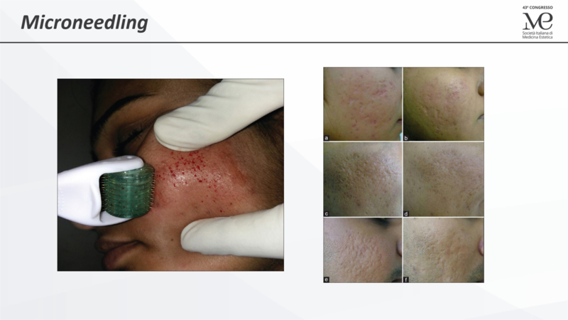 Microneedling